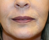 Feel Beautiful - Lip Lines and wrinkles around lips - Before Photo